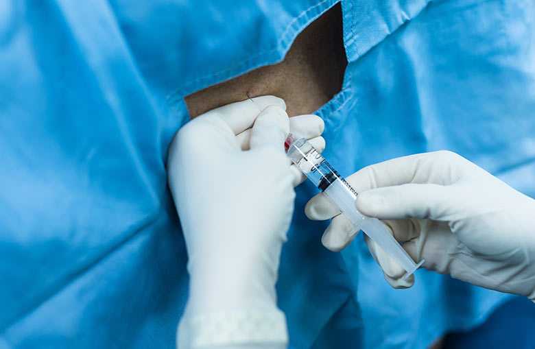 epidural injection